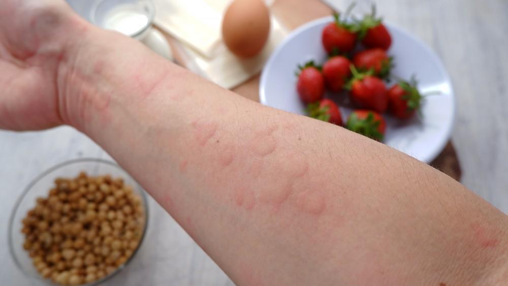 nut allergy